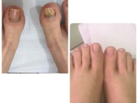 Foto: Antes e depois de tratamento feito pela podóloga Roneide de Souza Santos