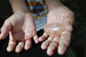 Menino de 6 anos tem mão queimada por mãe porque pegou dinheiro para levar à escola