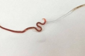 Médico remove parasita vivo de amídala de paciente