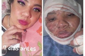 Chapa explode, provoca queimaduras em cantor sertanejo e mais duas pessoas em MS