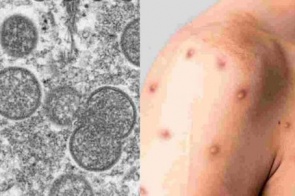 MS tem novo caso suspeito de varíola dos macacos paciente está internado