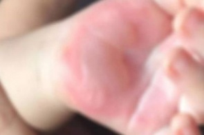Em MS, mãe queima dedos da filha de 11 anos em fogão como punição