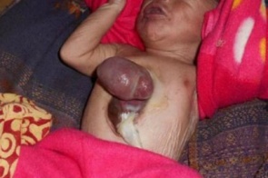 Bebê indiano nasce com coração fora do corpo e sobrevive