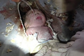 China: médicos suspeitam que bebê retirado de esgoto tenha fraturado crânio