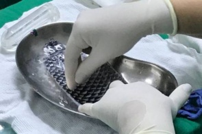 Brasil se torna pioneiro em reconstrução de vagina com pele de peixe