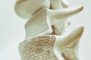 Osteoporose, a silenciosa doença incapacitante que pode ser fatal