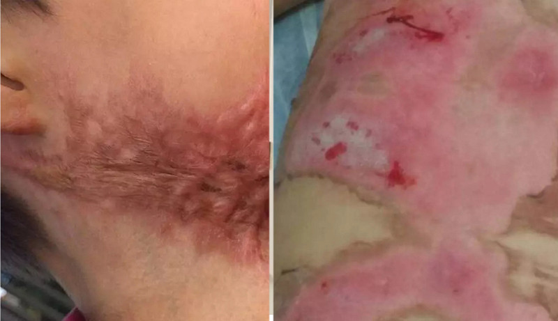 Imagens mostram queimadura em Kaio, à esquerda, e Naiany, à direita - Fotos: Reprodução